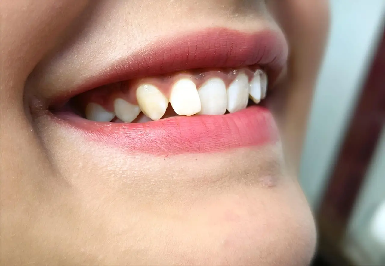 Beautiful Smile corrected by Dr. Saikat Paul